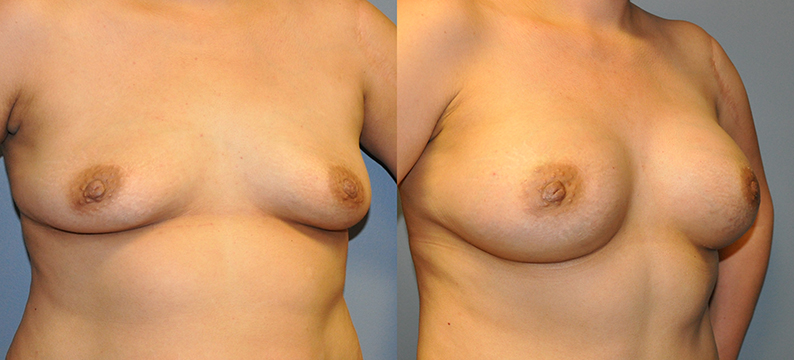 Breast Augmentation, Submuscular, Mentor HP, Cohesive Gel I, Siltex 425