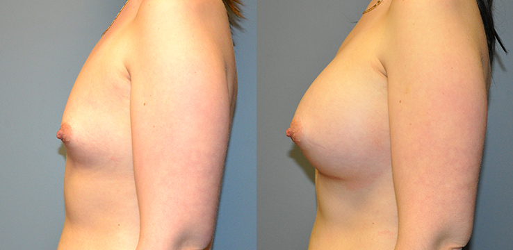 Breast Augmentation, Submuscular, Mentor HP, Cohesive Gel I, Siltex 425
