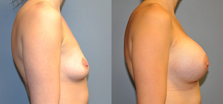 Breast Augmentation, Submuscular, Mentor UHP, Cohesive Gel I Siltex 400 (L), 430 (R)