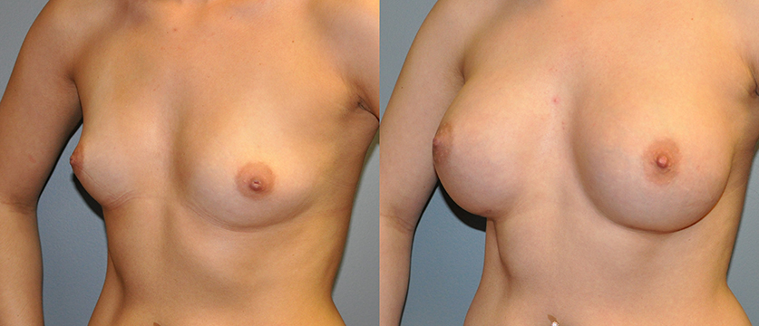 Breast Augmentation, Submuscular, Natrelle Inspira, Cohesive Gel I, Smooth SRX 370