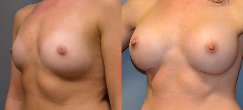 Breast Augmentation Submuscular, Natrelle Inspira, Coh I, Smooth, SRX 370, 2