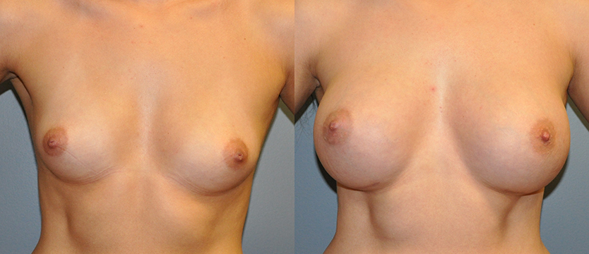Breast Augmentation, Submuscular, Natrelle Inspira, Cohesive Gel I, Smooth SRX 370