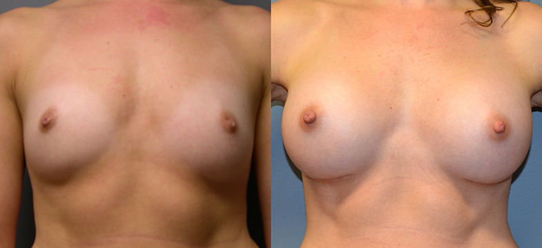 Breast Augmentation Submuscular, Natrelle Inspira, Coh I, Smooth, SRX 370