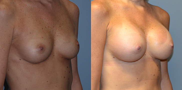 Breast Augmentation, Submuscular, Natrelle Inspira, SRX 285, Smooth Cohesive Gel I