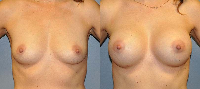 Breast Augmentation Submuscular,Mentor HP Coh I Siltex 325