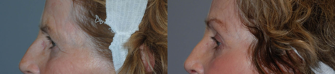 Eye Region Transformation: A comparison of the eye area's appearance before and after the brow lift
