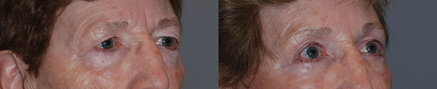 Elevated Brow Appearance: A before-and-after depiction of the lifted brow's enhancement