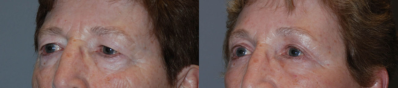 Brow Lift Outcome: Two photos revealing the noticeable change in the eye area post-procedure