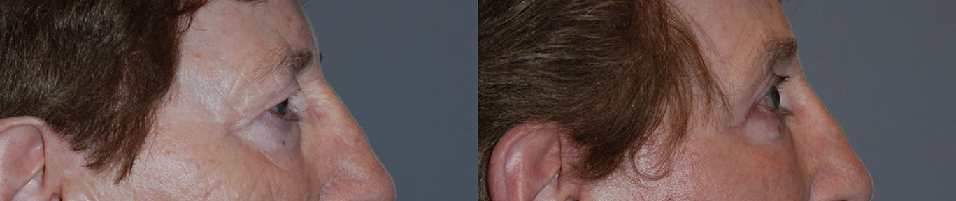 Restored Eyebrow Position: Images illustrating the lifted brow's transformative effect on the face