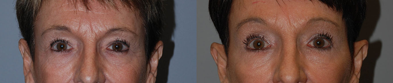 Brow Lift Results: Side-by-side visuals of the eye region's improvement after the procedure