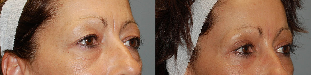 Brow Lift Transformation: A comparison showcasing the dramatic change in brow position