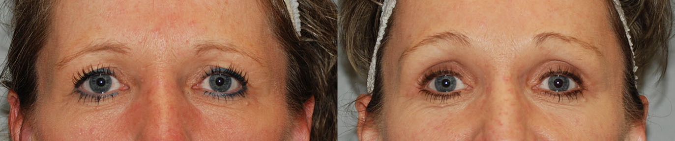 Brow Lift Progress: Two photos revealing the gradual improvement in the eye area