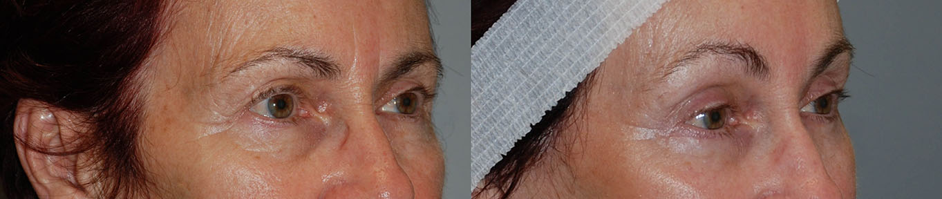 Transformed Eye Contours: Before and after images demonstrating the refined contours post-procedure