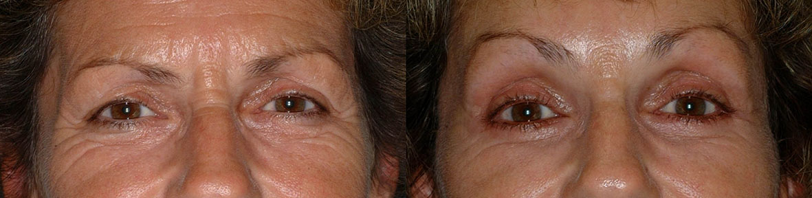 Eye Area Revitalization: Before and after shots showcasing the refreshed look post brow lift