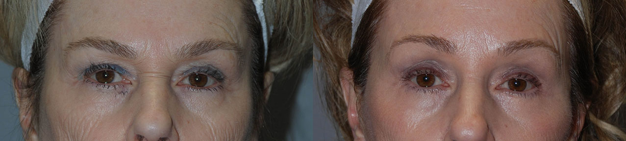 Brow Lift Impact: Visual evidence of the lifted brow's positive impact on facial symmetry