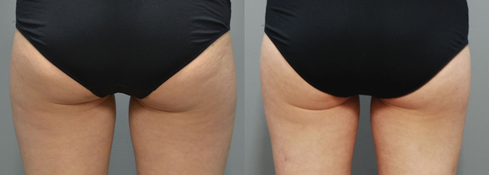 Cellulaze Progress: Comparative images illustrating the improvement in body contour