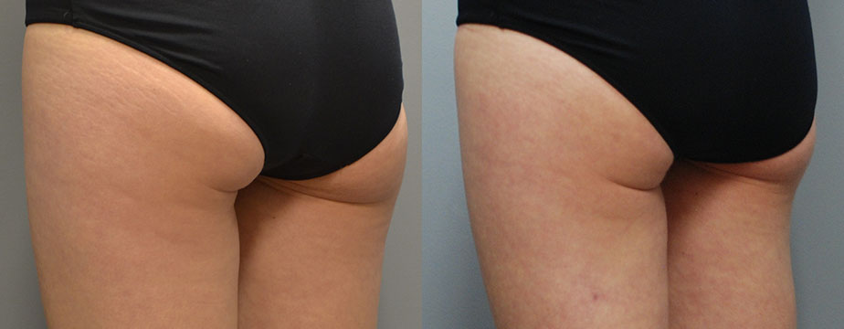 Body Transformation: Before-and-after photos showcasing Cellulaze treatment results