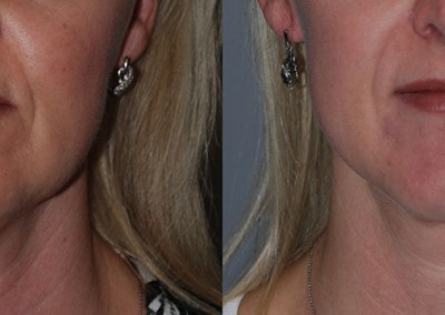 Before and After Neck Liposuction: Visual evidence of the contouring effects achieved through the treatment