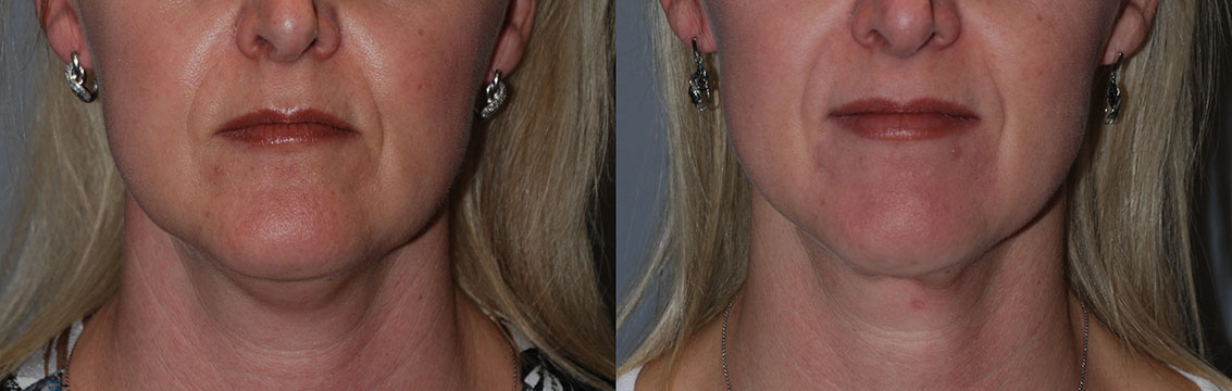 Before and After Neck Liposuction: Visual evidence of the contouring effects achieved through the treatment