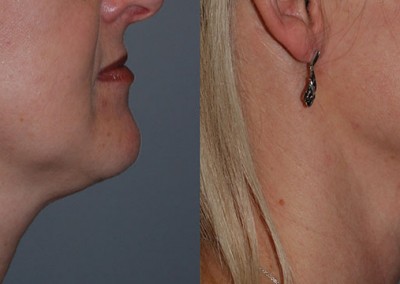 Neck Liposuction Results: A side-by-side comparison of chin and neck appearance pre and post-procedure