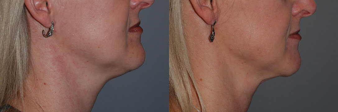 Neck Liposuction Results: A side-by-side comparison of chin and neck appearance pre and post-procedure