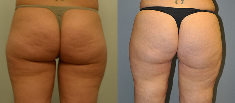 Before and After Cellulaze: Transformative snapshots revealing the smoothing effects of the procedure