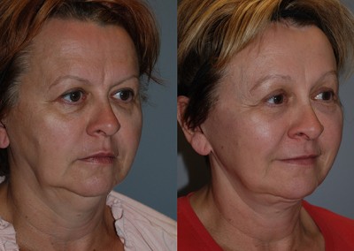 Revitalized facial appearance: Before vs after fat grafting on cheeks