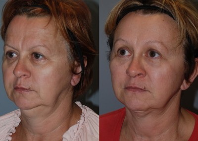 Sculpted cheekbones: Progression of fat grafting results on cheeks