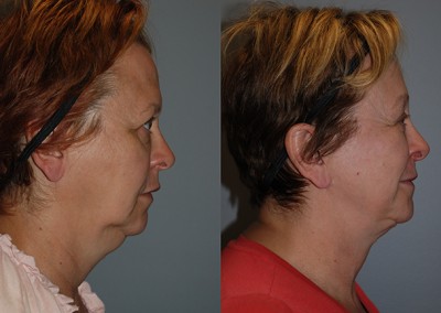 Enhanced cheek contours: Transformation through fat grafting procedure