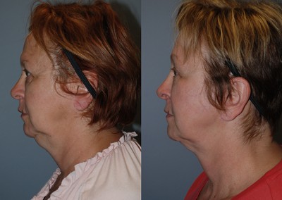 Cheek augmentation comparison: Before and after fat grafting on cheeks
