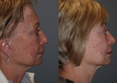 Age-defying facial rejuvenation: Transformation through fat grafting