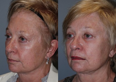 Natural-looking facial enhancement: Before and after fat grafting comparison