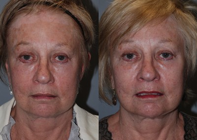 Subtle facial rejuvenation: Before vs after fat grafting images