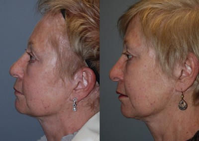 Revitalized facial contours: Fat grafting results showcased