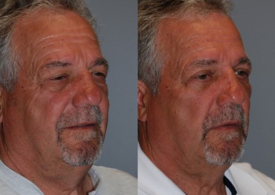 Rejuvenated facial contours: Fat grafting results showcased