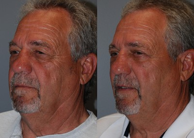 Restored facial fullness: Fat grafting results showcased