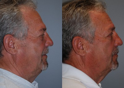Enhanced facial contours: Before and after fat grafting progression