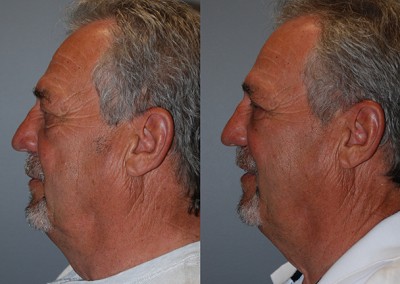 Radiant facial rejuvenation: Before vs after fat grafting images