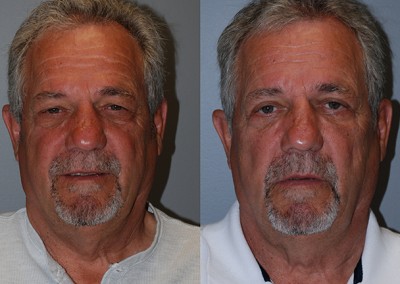 Harmonized facial aesthetics: Fat grafting transformation