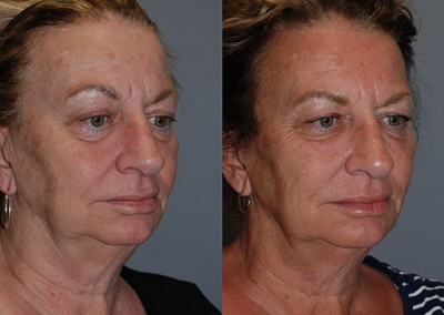 Enhanced facial symmetry: Before and after fat grafting progression