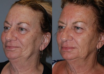 Facial harmony achieved: Fat grafting outcomes showcased