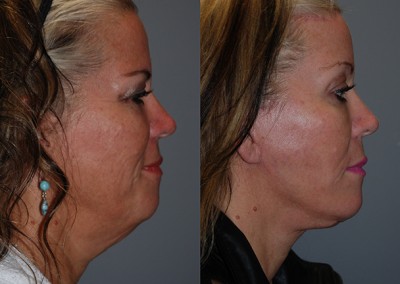 Facial symmetry achieved: Before vs after fat grafting images
