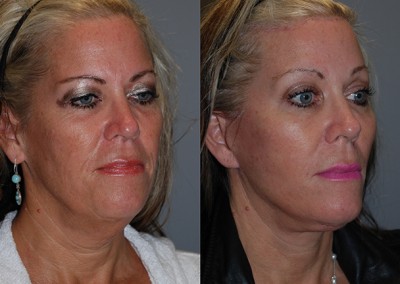 Restored facial fullness: Before and after fat grafting photos