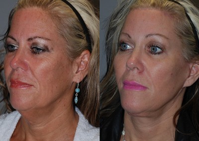 Facial rejuvenation journey: Fat grafting results illustrated