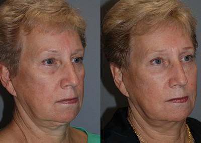 Balanced facial proportions: Before vs after fat grafting images