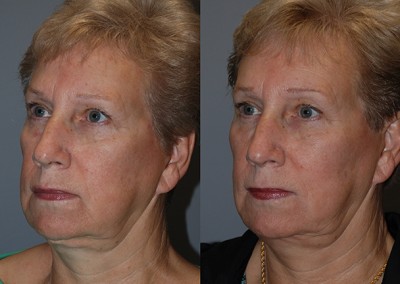 Facial volume enhancement: Fat grafting transformation