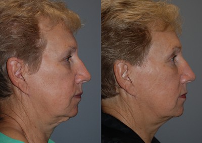 Rejuvenated facial features: Before and after fat grafting progression