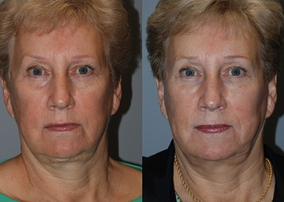 Enhanced facial definition: Before vs after fat grafting photos