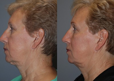 Youthful radiance restored: Fat grafting outcomes illustrated