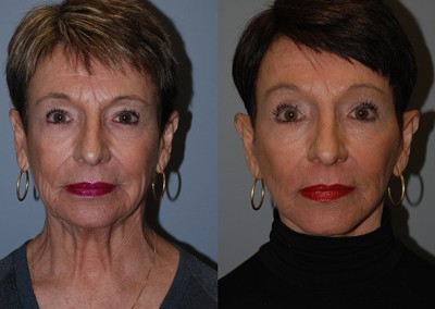 Balanced facial proportions: Before vs after fat grafting photos